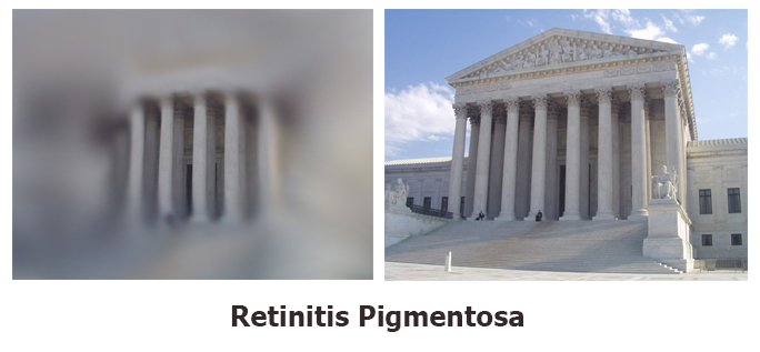 What in the hell is Retinitis&nbsp;Pigmentosa?